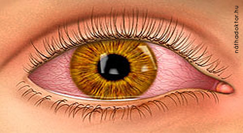 látóideg gyulladás a szenilis látás kezelése